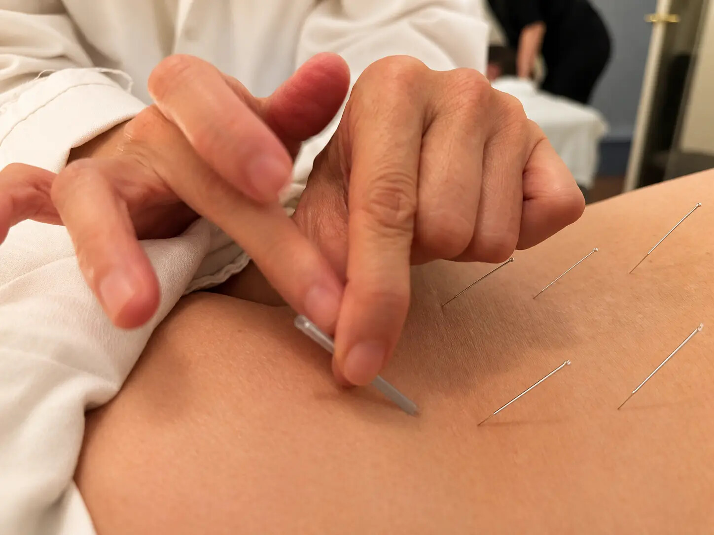 A detailed view of acupuncture care