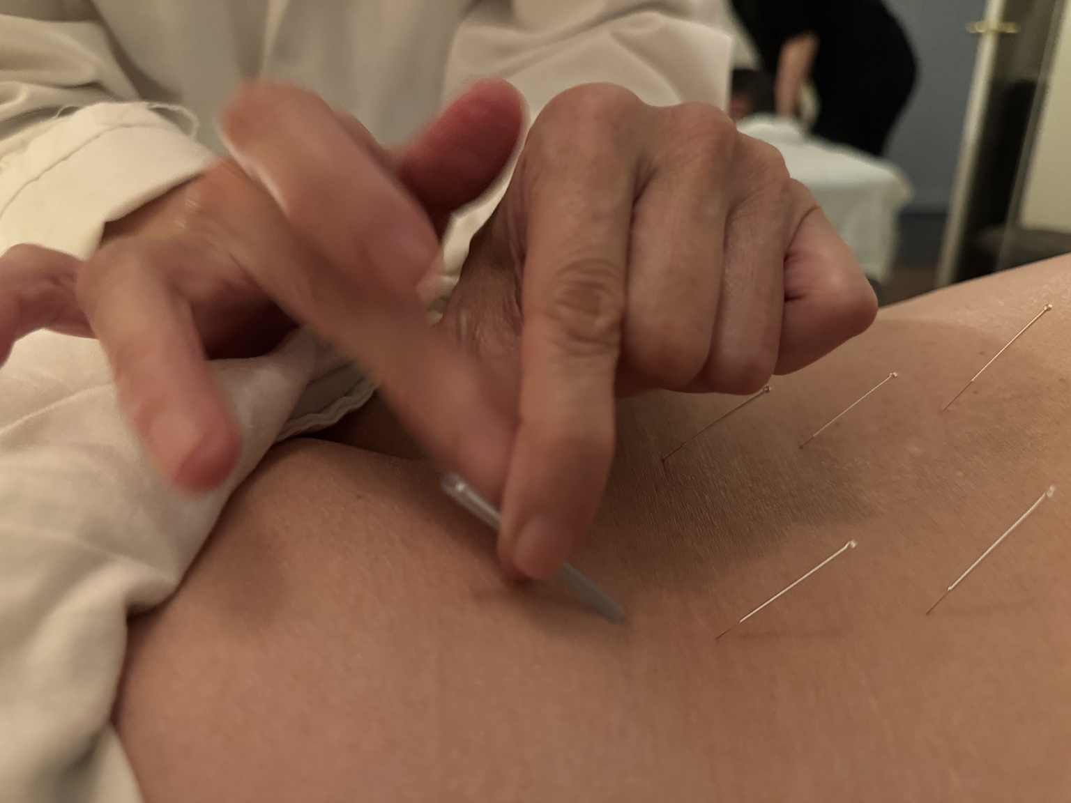A practitioner carefully placing acupuncture needles in a client's back